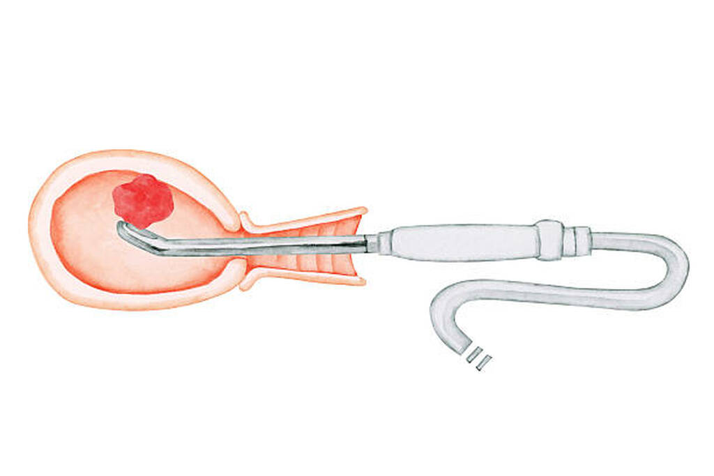 Best Urethral Stricture Treatment In Vashi